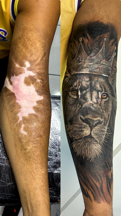 Cobertura de cicatriz feita em duas sessões de 5 horas cada